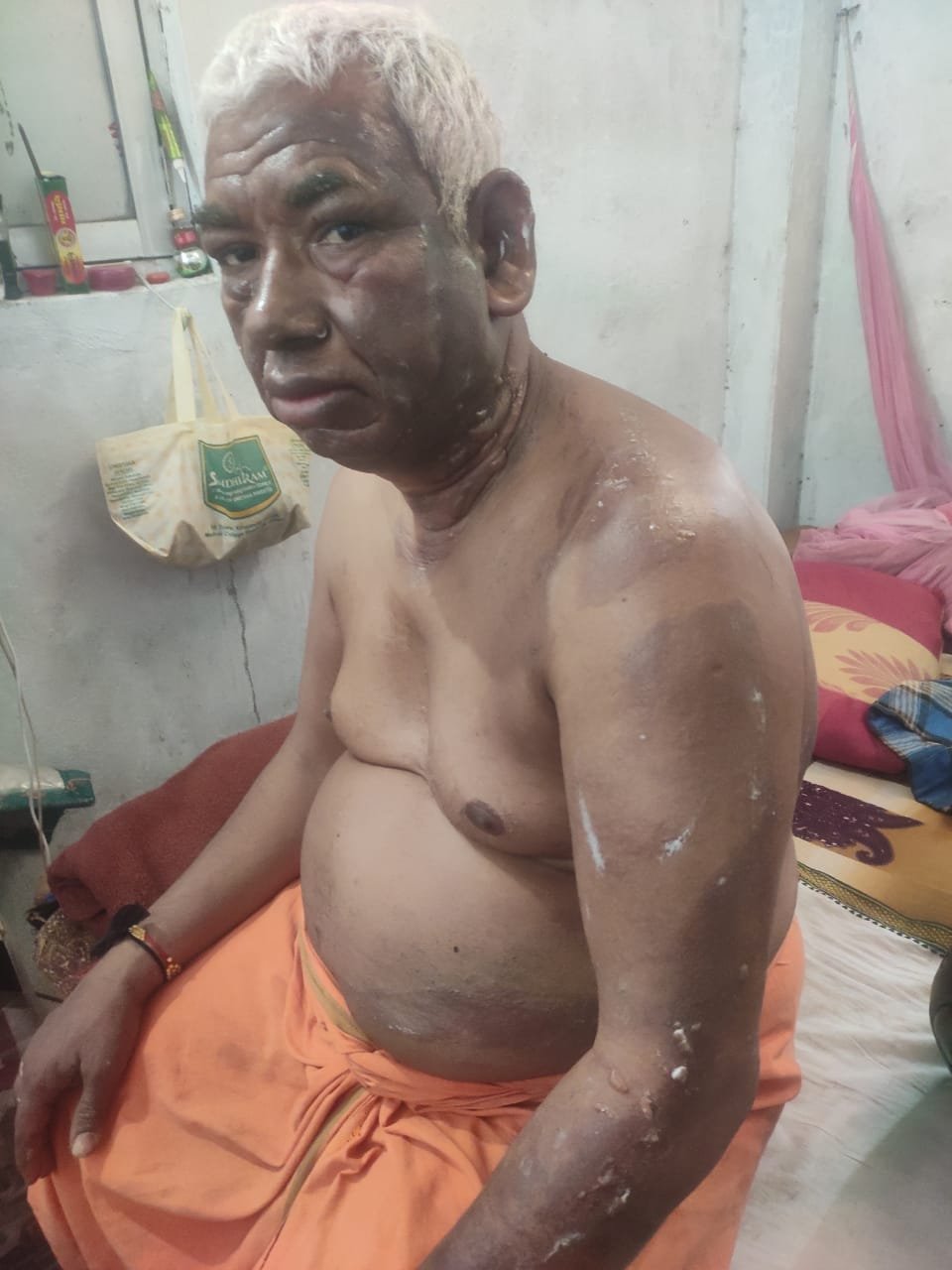 गैंस पाइपलाइन के लिकेज से बुरी तरह झुलस गया टी स्टॉल का दुकानदार 