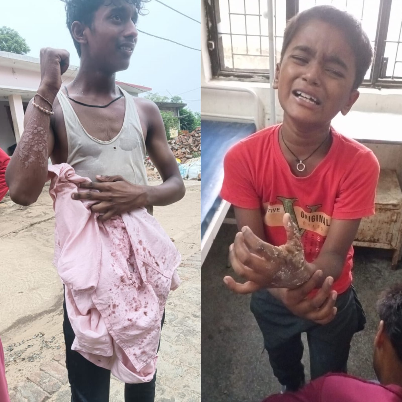 पैसे की लेनदेन में ज्वेलरी विक्रेता ने नाबालिक युवकों पर एसिड से किया अटैक