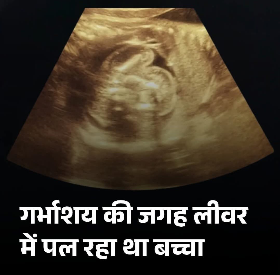 गर्भाशय की जगह लीवर में पल रहा था बच्चा
